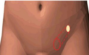 graphic depicting a hernia