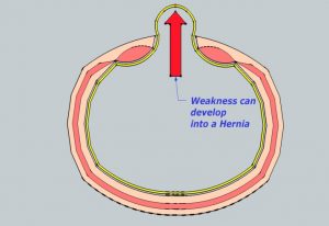 graphics depicting a hernia