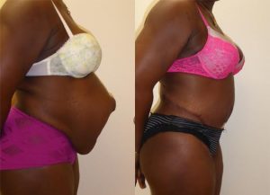 woman before and after hernia surgery