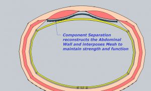 graphics showing the operated hernia