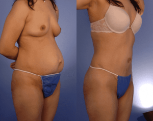 woman before and after hernia surgery