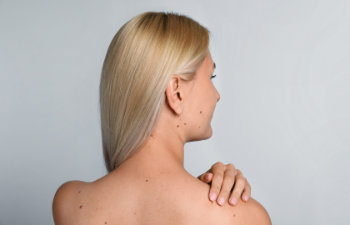 young woman with birthmarks on light grey background